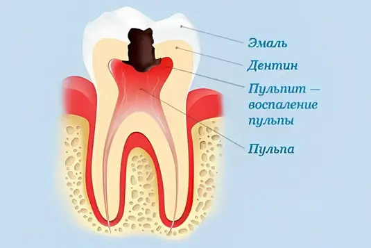 Що таке пульпа зуба, її функції фото