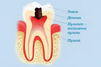 Що таке пульпа зуба, її функції