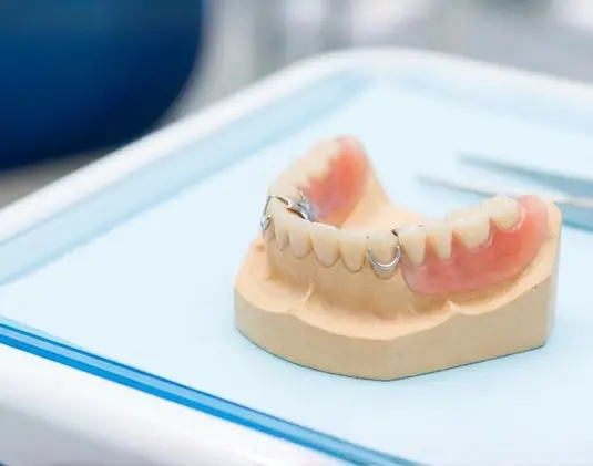 Бюгельне протезування зубів фото