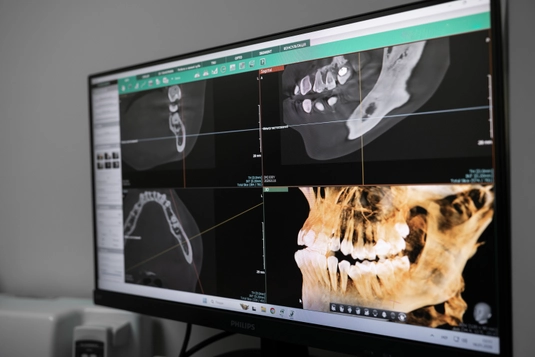 Синус-ліфтинг фото