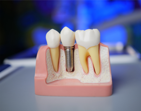 Dental prosthetics on implants photo