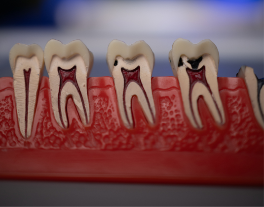 Dental filling photo