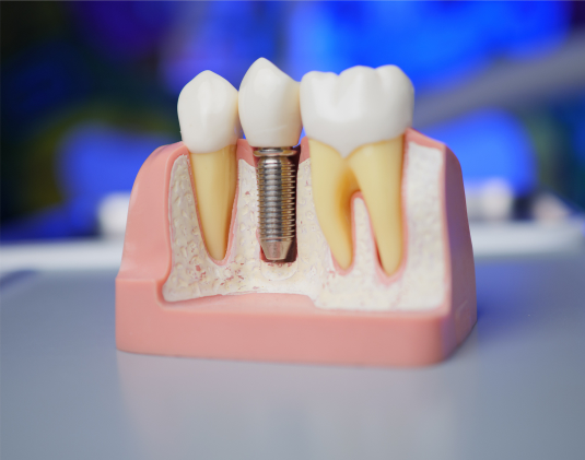 Turnkey dental implantation photo