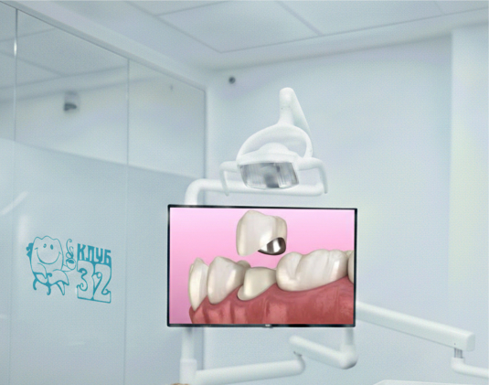 Metal-ceramic crown on an implant photo