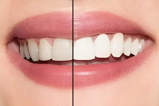 Teeth whitening photo