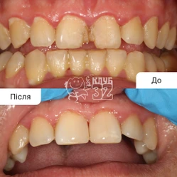 For your attention, the restoration of 2 frontal incisors