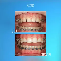 Final part of the orthodontic treatment