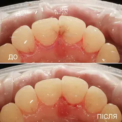 Result of caries treatment of frontal teeth