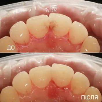 Result of caries treatment of frontal teeth