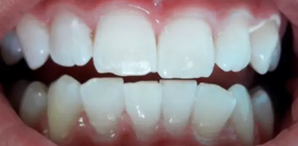 Teeth whitening after