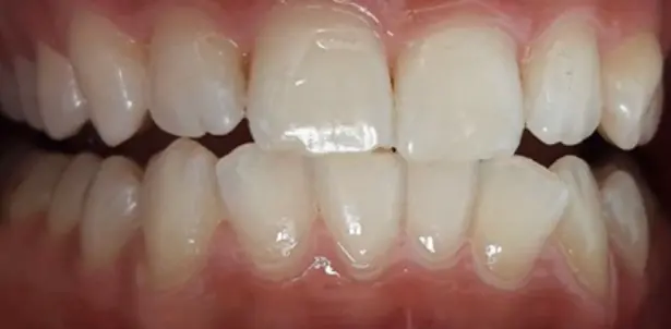 Teeth whitening before