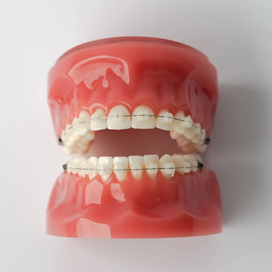 Ceramic braces photo