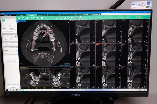 Panoramic X-ray photo