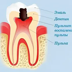 Что такое пульпа зуба, ее функции